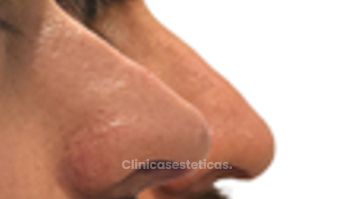Rinomodelación Masculina - Doctora Alexandra Mora