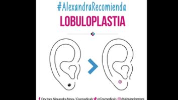 Lobuloplastia