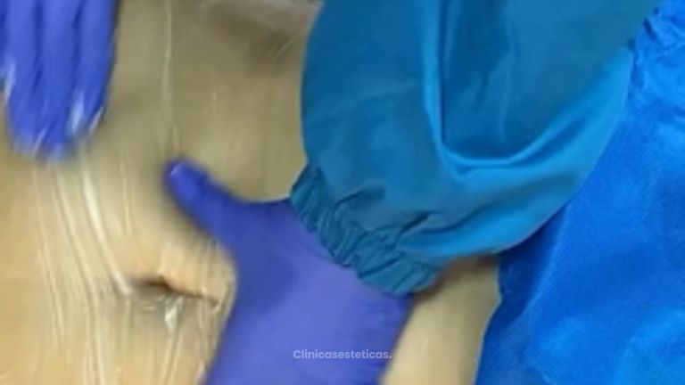 Moldeamiento Corporal - Dr. Fernando Pinedo Bischoff