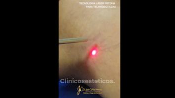 Láser Fotona para Telanciectasias - Dr. Juan Carlos Herrera P.