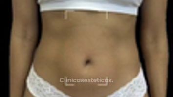 Lipoescultura Laser