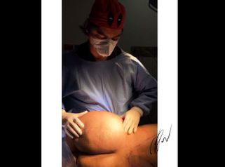 Gluteoplastia - Dr Jorge Puello White