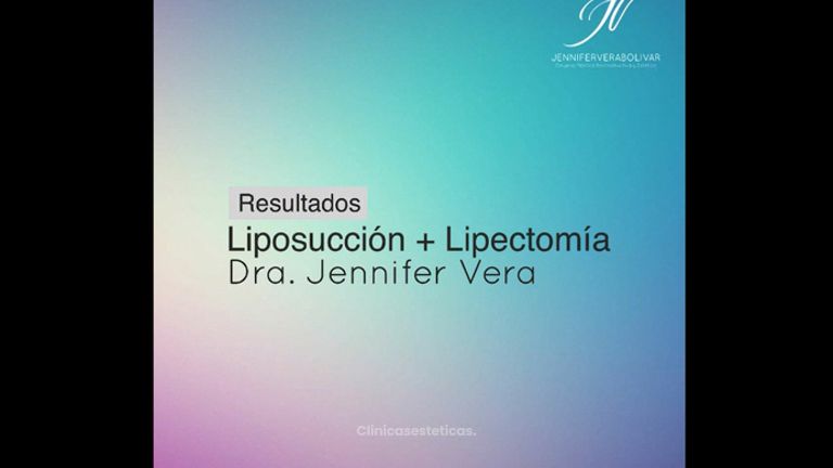 Liposucción + Lipectomía - Dra. Jennifer Vera Bolívar