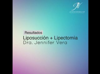 Liposucción + Lipectomía - Dra. Jennifer Vera Bolívar