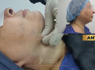Rejuvenecimiento facial - Dr. Juan Carlos Herrera P.
