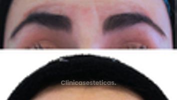 Toxina Botulínica - Doctora Alexandra Mora