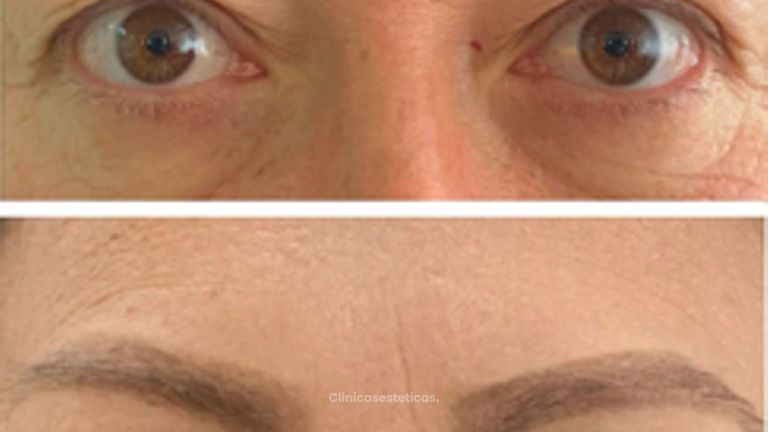 Blefaroplastia Superior - Doctora Alexandra Mora