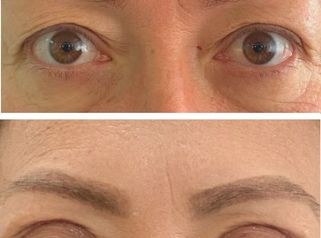 Blefaroplastia Superior - Doctora Alexandra Mora