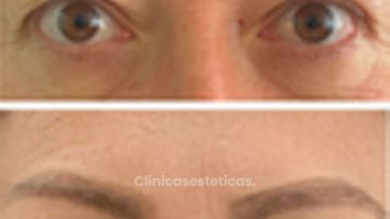 Blefaroplastia Superior - Doctora Alexandra Mora