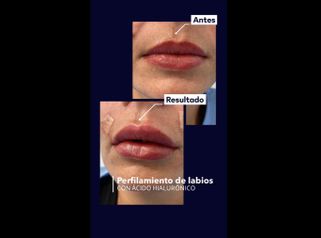 Aumento de labios - Idéaliste
