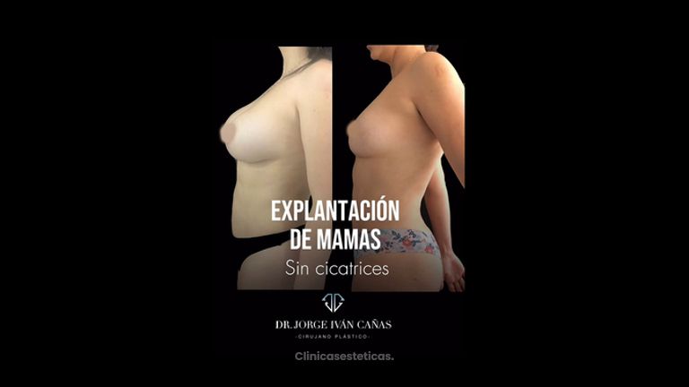 Levantamiento de senos - Dr. Jorge Iván Cañas Palacio