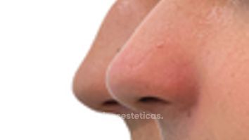 Rinoplastia en Hombres - Doctora Alexandra Mora