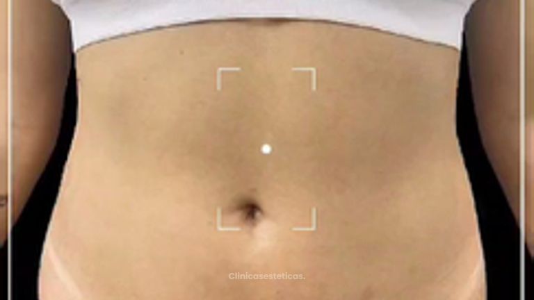 Lipoescultura - Dra. Ángeles Esmeral