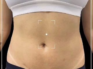 Lipoescultura - Dra. Ángeles Esmeral