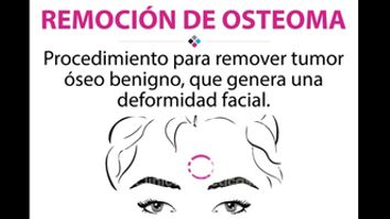 Remoción de osteoma