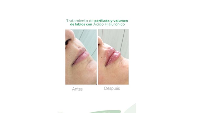 Aumento de labios - Massai Clínica