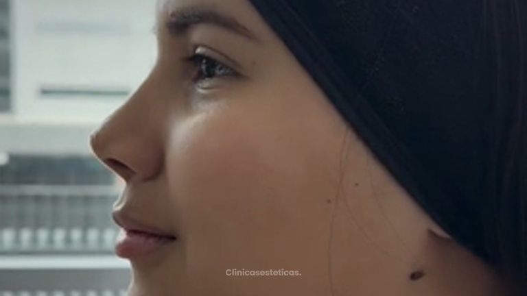 Rinomodelación - Dra. Yulieth Figueroa Peñaranda