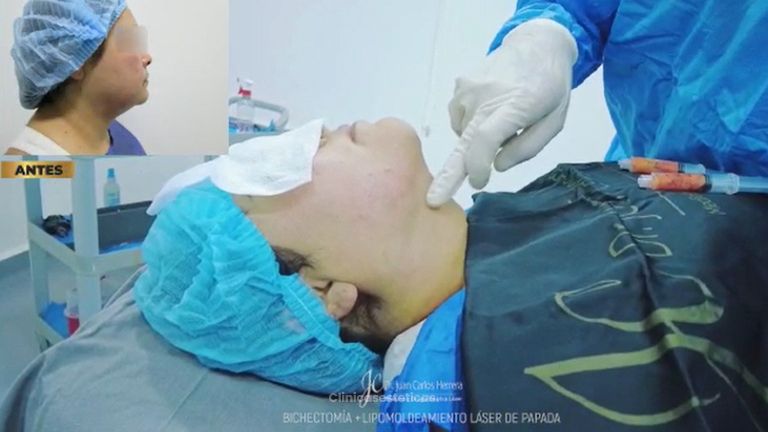 Bichectomía y lipoláser de papada - Dr. Juan Carlos Herrera P.