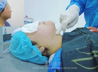 Bichectomía y lipoláser de papada - Dr. Juan Carlos Herrera P.