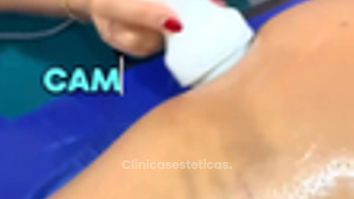 Masaje post Endolift - Dr. Miguel Ángel Cortés