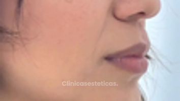 Rinomodelación - Dra. Yulieth Figueroa Peñaranda