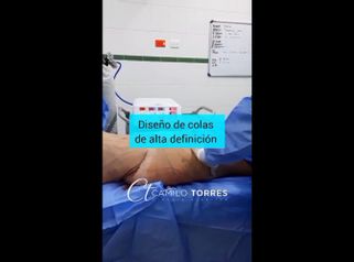 Liposucción - Dr. Camilo Rafael Torres Rodríguez