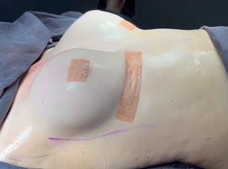 Mamoplastia de aumento - Dra. Mariana Ríos