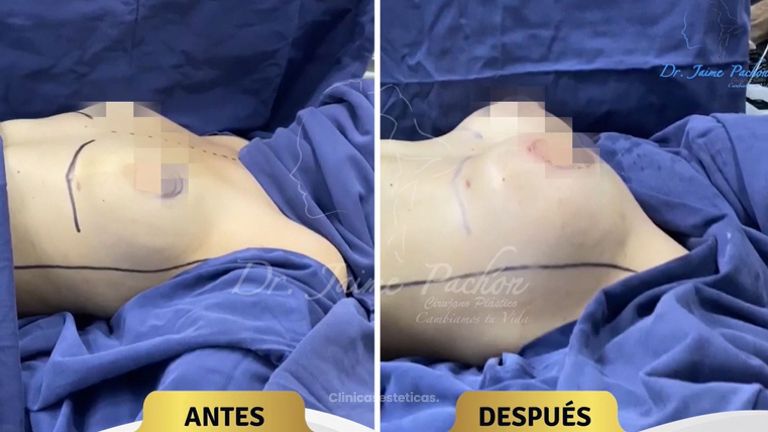 Mamoplastia de aumento - Dr. Jaime Pachón