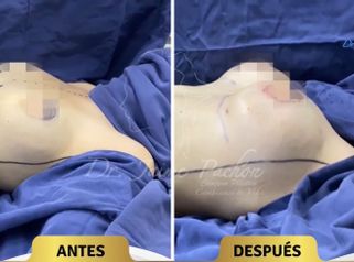 Mamoplastia de aumento - Dr. Jaime Pachón
