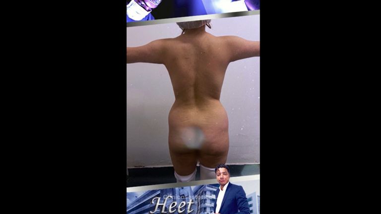 Liposucción - Dr. Jarold Effer Taylor