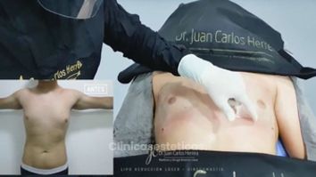 Ginecomastia - Dr. Juan Carlos Herrera P.