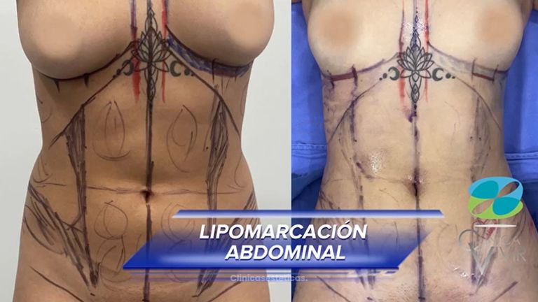 Liposucción - Clínica Vivir