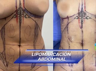 Liposucción - Clínica Vivir