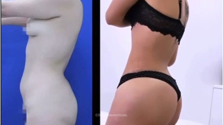 Antes y después Gluteoplastia