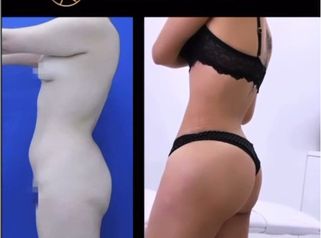 Antes y después Gluteoplastia