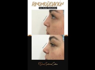 Rinomodelación - Dr. Juan Guillermo Cadena