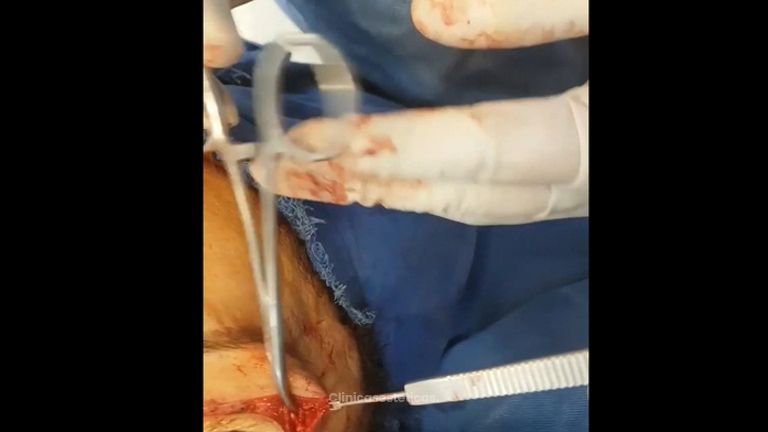 Blefaroplastia