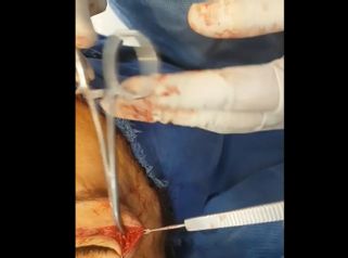 Blefaroplastia