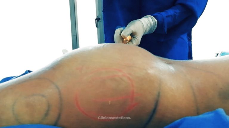 Gluteoplastia - Dr. Johnatan L De Guevara