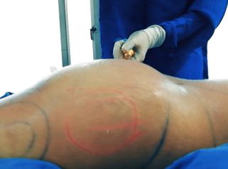 Gluteoplastia - Dr. Johnatan L De Guevara