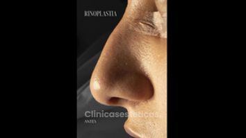 Rinoplastia - Dr. Luis Fernando Reyes & Dra. Nicole Echeverry