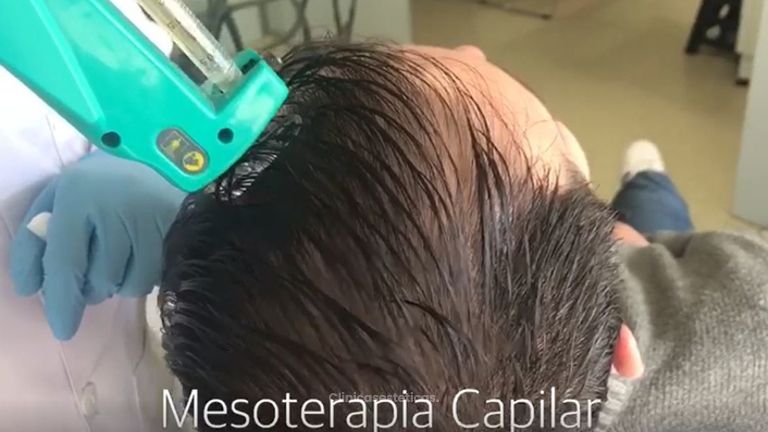 Mesoterapia Capilar