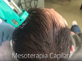 Mesoterapia Capilar