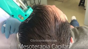 Mesoterapia Capilar