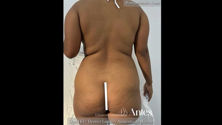 Lipoescultura - Dr. Reinel Mesa