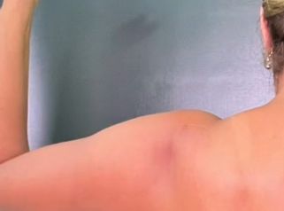 Liposucción de Brazos - Dr. Reinel Mesa