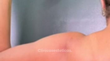 Liposucción de Brazos - Dr. Reinel Mesa