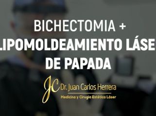Bichectomía - Dr. Juan Carlos Herrera P.