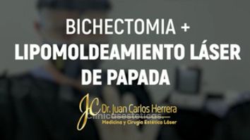 Bichectomía - Dr. Juan Carlos Herrera P.