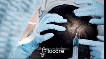 Implantes de Cabello